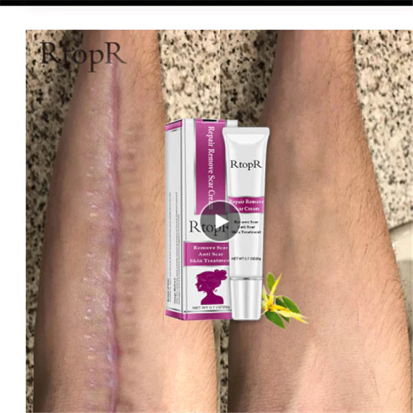 Acne Scar Removal Cream for Skin Repair and Healing